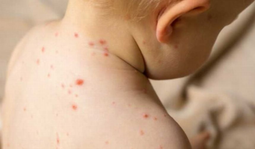 DSÖ’ye göre kızamık hastalığının endemik hale geldiği 12 ülke arasında Türkiye de var